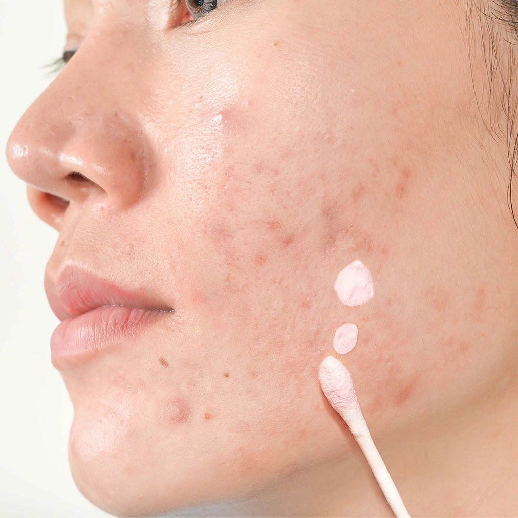 Luv it! Anti-Acne Lotion 30 ml